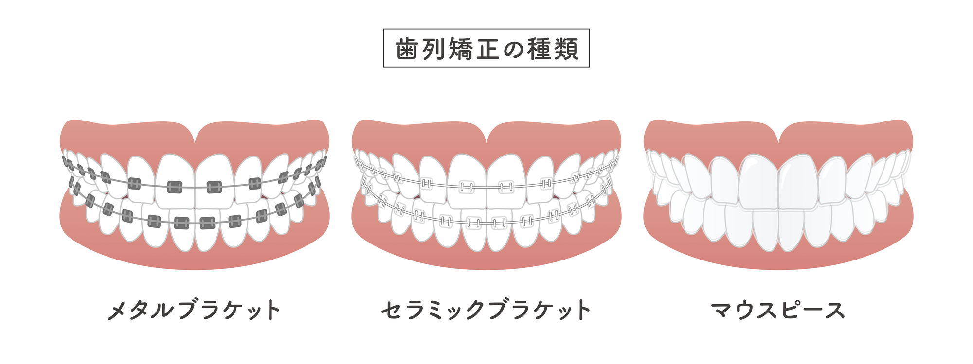 歯列矯正の種類
